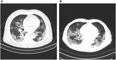 COVIDNet-CT: A Tailored Deep Convolutional Neural Network Design for Detection of COVID-19 Cases From Chest CT Images